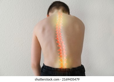 part of naked back of boy, child 8-10 years old is standing, hunched over from back pain, concept of therapeutic massage for osteochondrosis, scoliosis, back pain, intervertebral hernia