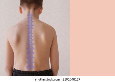 Part Of Naked Back Of Boy, Child 8-10 Years Old Is Standing, Good Posture, Straight Back, Prevention Of Scoliosis In Childhood, Health, Strengthening Of The Spine