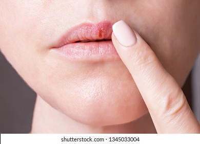 xq sale el herpes labial
