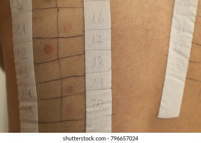 Patch test for allergic reaction (allergic contact dermatitis)