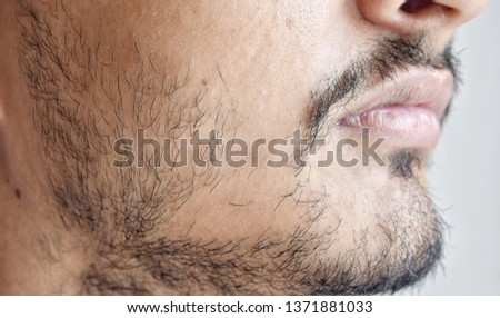 Patchy Beards In Male