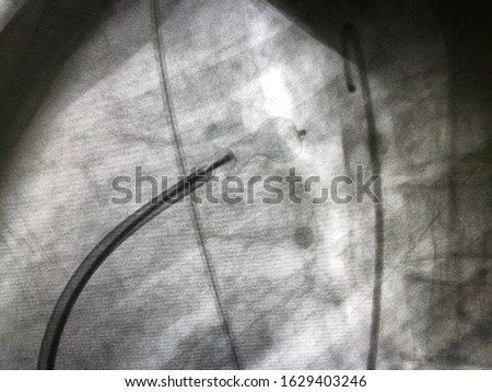 patent ductus arteriosus (PDA) in adult,  which is congenital heart disease, already closed by deployed PDA closure device via endovascular procedure