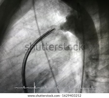 patent ductus arteriosus (PDA) in adult,  which is congenital heart disease, already closed by deployed PDA closure device via endovascular procedure