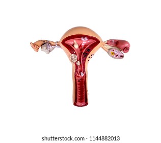 Pathological Female Uterus And Ovary Medical Anatomy Model. Clipping Path