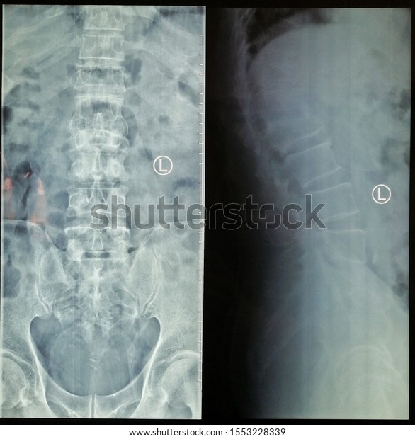 Pathological Fracture L1 L2 Lumbar Vertebra Stock Photo 1553228339 ...