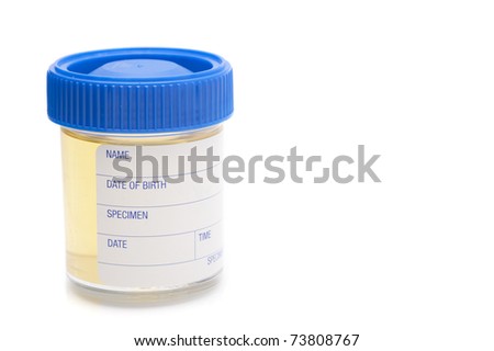 pathology test sample jar containing a urine specimen