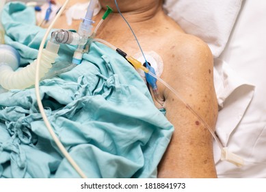 Patient Asian Elder Woman 80s Flu Covid19 Do Tracheostomy Use Ventilator For Respiration Breathing Help On Patient Bed In Intensive Care Unit (ICU.) Room At Hospital In Concept Healthcare In Life