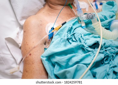 Patient Asian Elder Woman 80s Flu Covid19 Do Tracheostomy Use Ventilator For Respiration Breathing Help On Patient Bed In Intensive Care Unit (ICU.) Room At Hospital In Concept Healthcare In Life