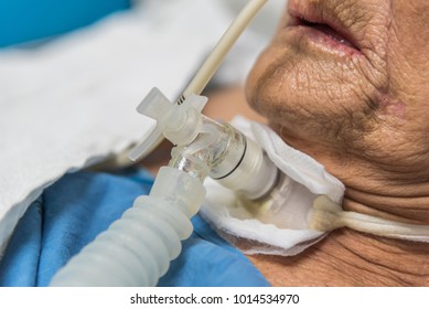 Patient Asian Elder Women 80s Do Tracheostomy Use Ventilator For Breathing Help On Bed In The Hospital.