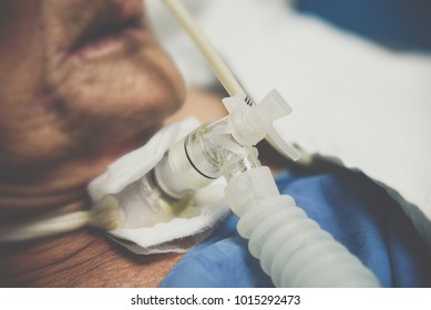 Patient asian elder women 80s do tracheostomy use ventilator for breathing help on bed in the hospital.