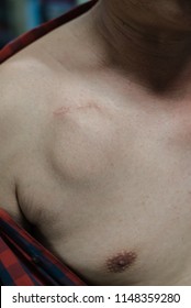 implantable cardioverter defibrillator scar