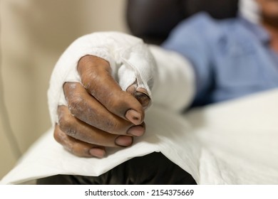 Patient With Burns In The Hospital. Applying Bandage Onto Patient's Arm Burn Wound.