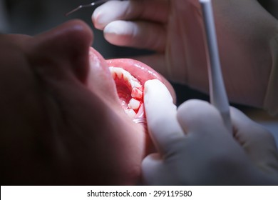 Patient at dental hygienists office, getting teeth cleaned of tartar and plaque, bleeding, preventing periodontal disease. Dental hygiene, painful procedures and prevention concept. 
