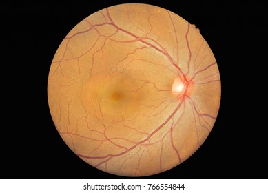 Patient Elderly With Retina Of Diabetes.