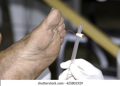 Patient has his foot examined by a health professional. This person does Mono-filament test to check your sensitivity