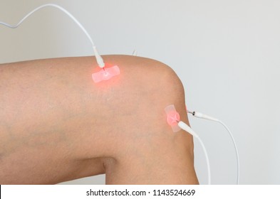 Patient having electrode therapy, or electrical muscle stimulation, on a benting knee joint using electrical stimulation to treat muscle pain and prevent atrophy after injury