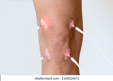 Patient having electrode therapy, or electrical muscle stimulation, on a knee joint using electrical stimulation to treat muscle pain and prevent atrophy after injury