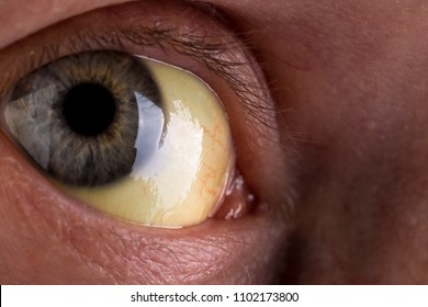 Patient With Jaundice. Close-up Shot Of Yellowed Eyes. Severe Form Of Hepatitis. Medical Concept. Life And Health.