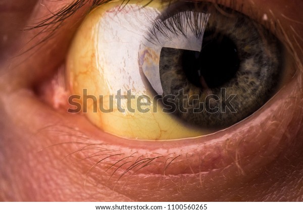 黄疸の患者 黄色い目の接写 重症の肝炎 医療のコンセプト 生命と健康 の写真素材 今すぐ編集