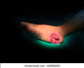 Patient lying on the bed waiting for surgery wound at heel