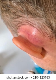 Patient With Massive Swelling Behind The Left Ear Due To Persisting Acute Otitis Media After Mastoidectomy Surgery