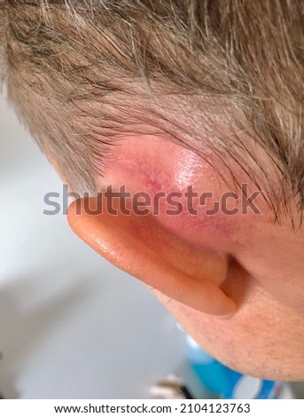 Patient with massive swelling behind the left ear due to persisting acute otitis media after mastoidectomy surgery