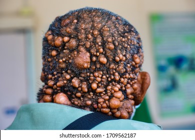 Patient  With Neurofibromatosis,Genetic Disorder Symptoms Include Tumors On Skin.