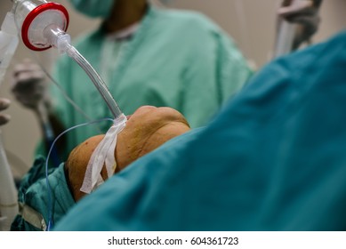 Patient on endotracheal tube,endotracheal tube in patient's mouth at hospital.