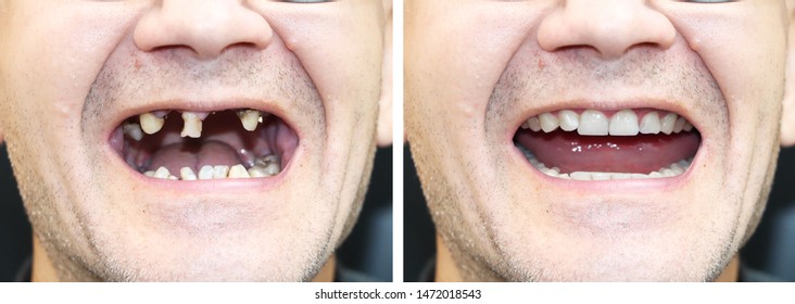 The patient at the orthodontist before and after the installation of dental implants. Tooth loss, decayed teeth, denture, veneers - Shutterstock ID 1472018543