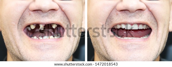 The patient at the orthodontist before and after\
the installation of dental implants. Tooth loss, decayed teeth,\
denture, veneers