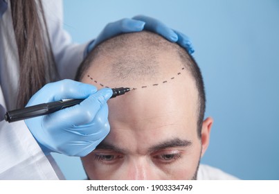 Patient Suffering From Hair Loss In Consultation With A Doctor. Doctor Using Skin Marker