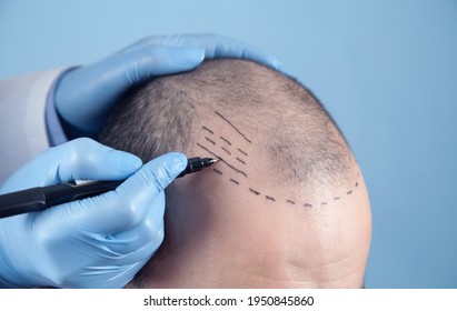 Patient suffering from hair loss in consultation with a doctor. Doctor using skin marker - Shutterstock ID 1950845860