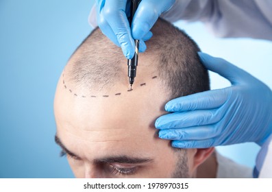 Patient Suffering From Hair Loss In Consultation With A Doctor. Doctor Using Skin Marker