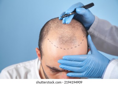 Patient Suffering From Hair Loss In Consultation With A Doctor. 