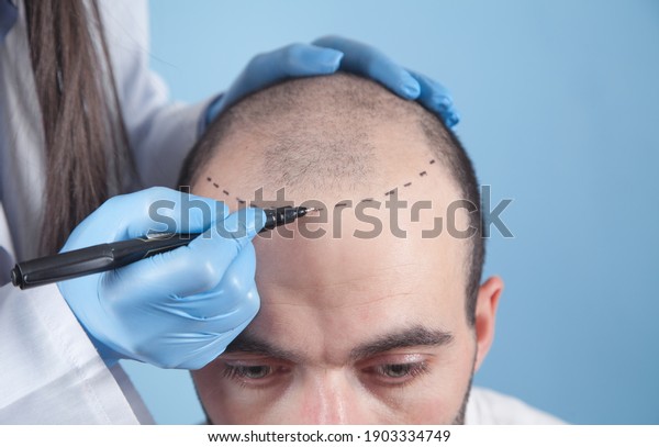 Patient suffering from hair loss in\
consultation with a doctor. Doctor using skin\
marker