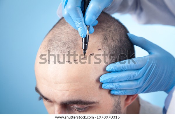 Patient suffering from hair loss in
consultation with a doctor. Doctor using skin
marker