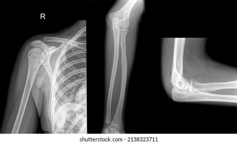 Patient X Ray. X Ray Of A Arm, Forearm And Elbow.