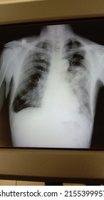 Patient X Ray Result Of Chest With Tuberculose In Left Lung