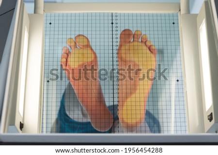 The patient's feet are placed on a special apparatus for determining the load. On one foot, the load is uniform, the second foot is on the toe. It is clearly seen how the load is distributed when