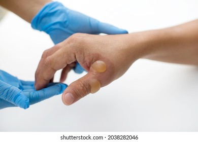 Patient's hand and thumb with heat blister and injuries. Blisters on body parts.Wound care in hospital white table.Skin wounds.Patient with serious burns.First and second degree burn.Emergency care.