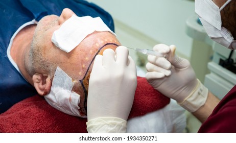 Patient's Head Close-up. Baldness Treatment. Hair Transplant. Surgeon In The Operating Room Carry Out Hair Transplant Surgery. 