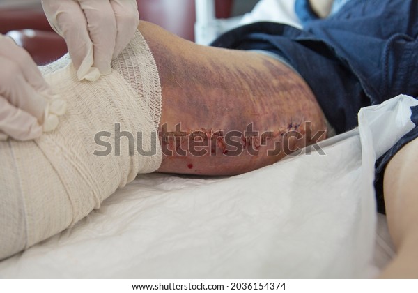 The patient\'s leg is wrapped in a bandage after\
dressing by the nurse. Post-operative, patient care, edema,\
surgical metal staple\
suture.
