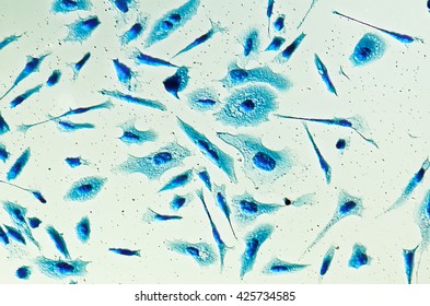 Cáncer de próstata PC3