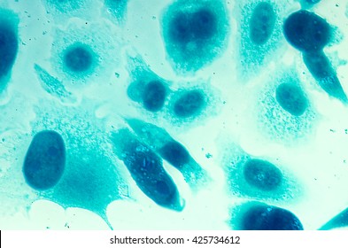 PC-3 human prostate cancer cells, stained with Coomassie blue, under differencial interference contrast microscope. - Shutterstock ID 425734612