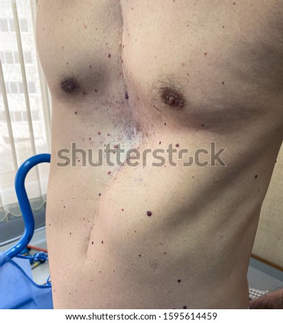 Pectus Excavatum - Sunken Chest in a mature man and sternum surgical scar