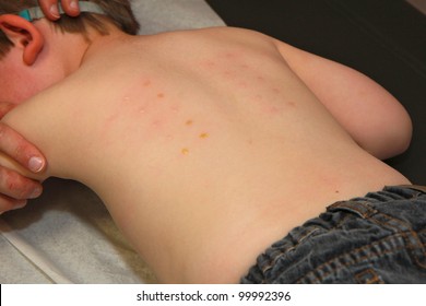 Pediatric Allergy Skin Test