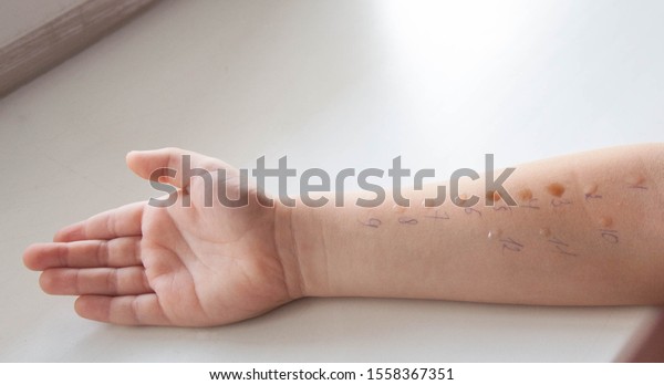 Pediatric allergy skin\
test on child\'s hand 