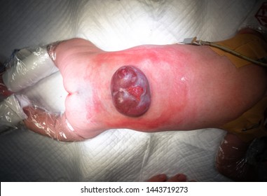 Pediatric Or A Baby With A Spinal Defect At Birth Called Myelomeningocele. A Spinal Defect Showing Remnants Of Embryology, Like The Neural Placode And A Bulging Skin, Filled With CSF