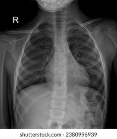Pediatric chest X-ray displaying the developing ribcage and heart anatomy.
