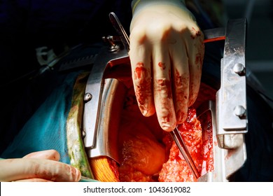 Pediatric Heart Surgery, Close-up Doctor Doing Heart Operation